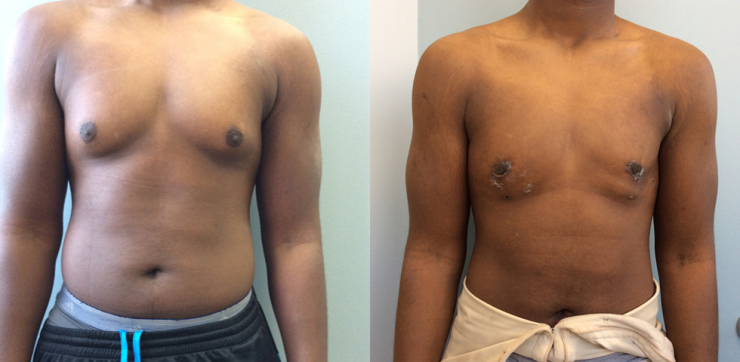 Gynecomastia Before and After Pictures