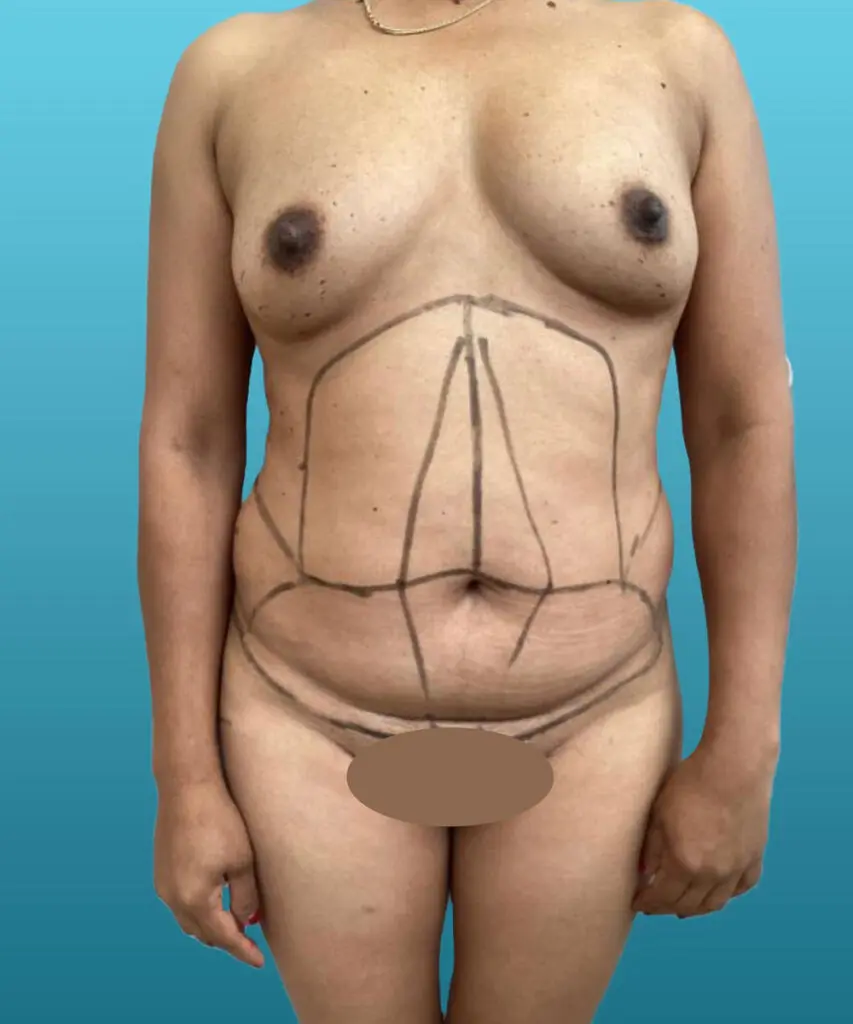 Mommy Makeover Before and After Pictures Columbia, SC