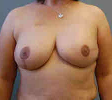 Breast Reconstruction Before and After Pictures Columbia, SC