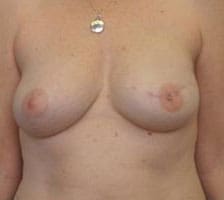 Breast Reconstruction Before and After Pictures Columbia, SC