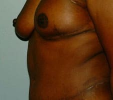 Breast Reconstruction Before and After Pictures Columbia, SC