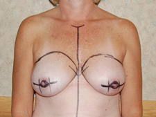 Breast Reconstruction Before and After Pictures Columbia, SC