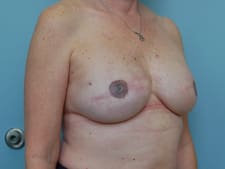 Breast Reconstruction Before and After Pictures Columbia, SC