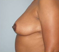 Breast Reduction Before and After Pictures Columbia, SC