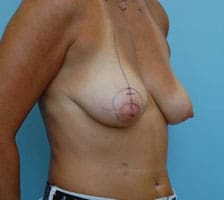 Breast Lift Before and After Pictures Columbia, SC