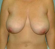 Breast Lift Before and After Pictures Columbia, SC