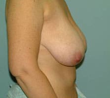 Breast Lift Before and After Pictures Columbia, SC