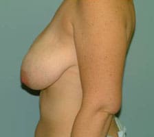 Breast Lift Before and After Pictures Columbia, SC