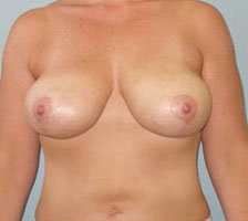 Breast Lift Before and After Pictures Columbia, SC