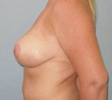 Breast Lift Before and After Pictures Columbia, SC