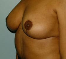 Breast Lift Before and After Pictures Columbia, SC
