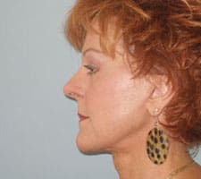 Facelift Before and After Pictures Columbia, SC