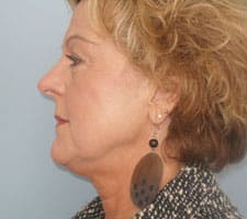 Facelift Before and After Pictures Columbia, SC