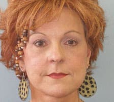 Facelift Before and After Pictures Columbia, SC