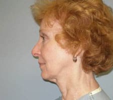 Facelift Before and After Pictures Columbia, SC