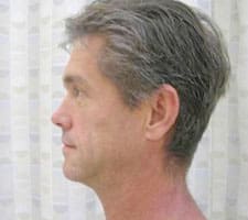 Facelift Before and After Pictures Columbia, SC