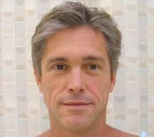 Facelift Before and After Pictures Columbia, SC