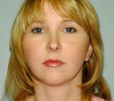 Facelift Before and After Pictures Columbia, SC