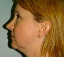 Facelift Before and After Pictures Columbia, SC