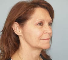 Facelift Before and After Pictures Columbia, SC