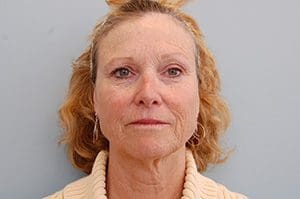 Facelift Before and After Pictures Columbia, SC