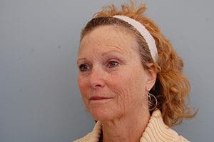 Facelift Before and After Pictures Columbia, SC