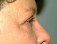 Blepharoplasty Before and After Pictures Columbia, SC