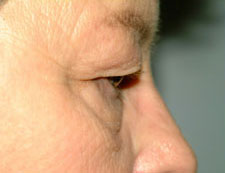 Blepharoplasty Before and After Pictures Columbia, SC