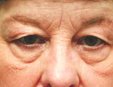 Blepharoplasty Before and After Pictures Columbia, SC