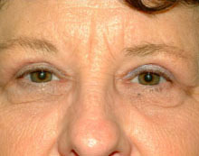 Blepharoplasty Before and After Pictures Columbia, SC