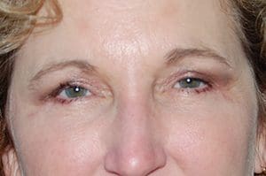 Blepharoplasty Before and After Pictures Columbia, SC