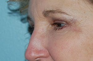 Blepharoplasty Before and After Pictures Columbia, SC