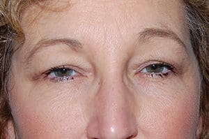 Blepharoplasty Before and After Pictures Columbia, SC