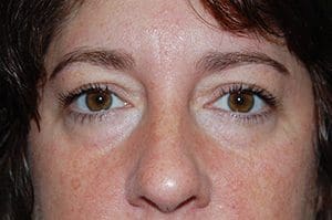 Blepharoplasty Before and After Pictures Columbia, SC