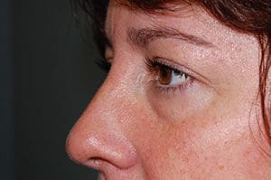 Blepharoplasty Before and After Pictures Columbia, SC