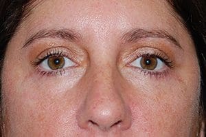 Blepharoplasty Before and After Pictures Columbia, SC