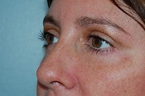 Blepharoplasty Before and After Pictures Columbia, SC