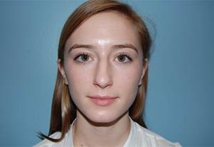 Rhinoplasty Before and After Pictures Columbia, SC