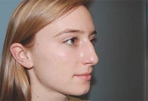 Rhinoplasty Before and After Pictures Columbia, SC