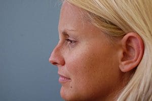 Rhinoplasty Before and After Pictures Columbia, SC