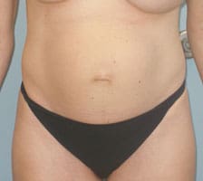 Tummy Tuck (Anterior Torsoplasty) Before and After Pictures Columbia, SC