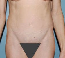 Tummy Tuck (Anterior Torsoplasty) Before and After Pictures Columbia, SC