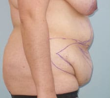 Tummy Tuck (Anterior Torsoplasty) Before and After Pictures Columbia, SC