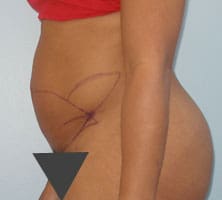 Tummy Tuck (Anterior Torsoplasty) Before and After Pictures Columbia, SC