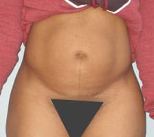 Tummy Tuck (Anterior Torsoplasty) Before and After Pictures Columbia, SC