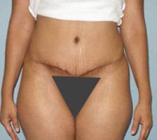 Tummy Tuck (Anterior Torsoplasty) Before and After Pictures Columbia, SC