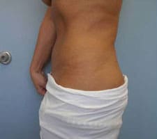 Tummy Tuck (Anterior Torsoplasty) Before and After Pictures Columbia, SC