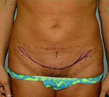 Tummy Tuck (Anterior Torsoplasty) Before and After Pictures Columbia, SC