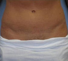 Tummy Tuck (Anterior Torsoplasty) Before and After Pictures Columbia, SC