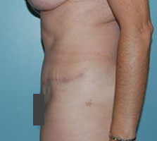 Tummy Tuck (Anterior Torsoplasty) Before and After Pictures Columbia, SC